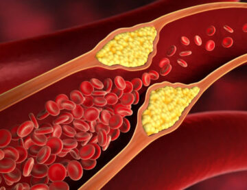 Colesterol crescut, cum il scadem prin mijloace naturale?