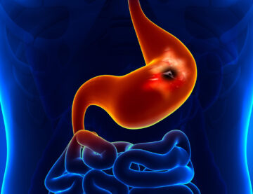 Ulcerul: Cauze, simptome si tratament